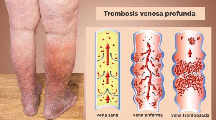 Pierna con signos de trombosis venosa profunda