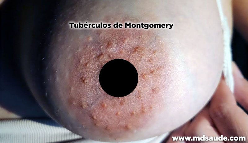 Tubérculos de Montgomery