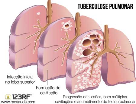 Tuberculose