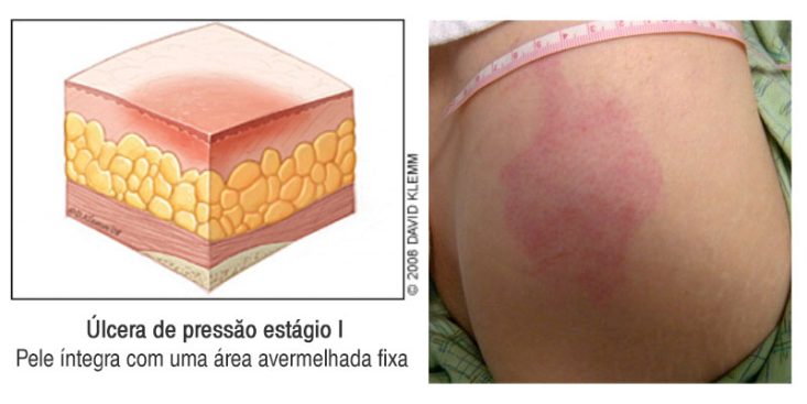 Úlcera de pressão estágio 1