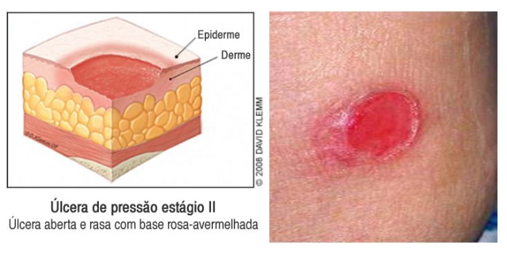 Úlcera de pressão estágio 2