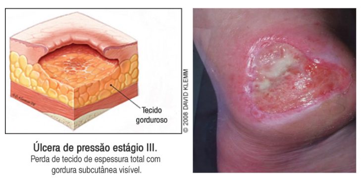 Úlcera de pressão estágio 3