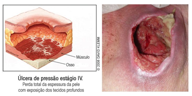 Úlcera de pressão estágio 4