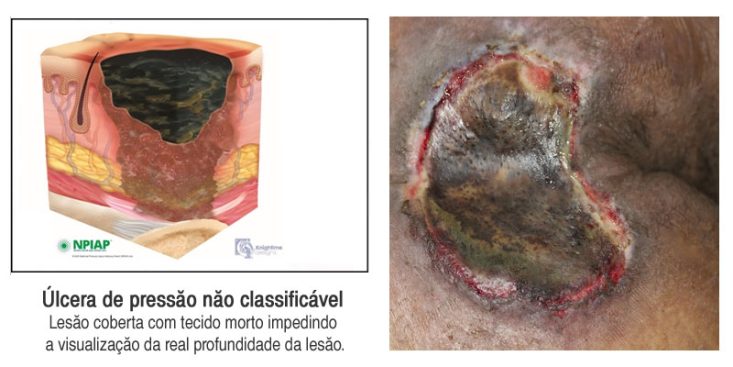 Úlcera de pressão não classificável
