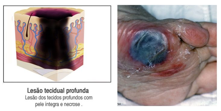 Lesão tecidual profunda