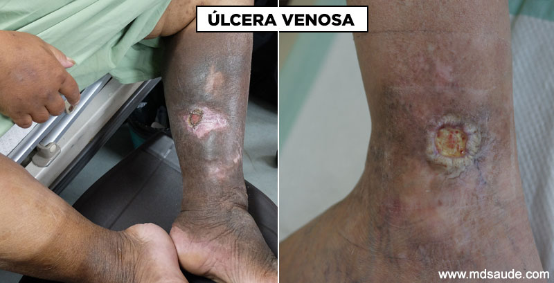 Úlcera de estase