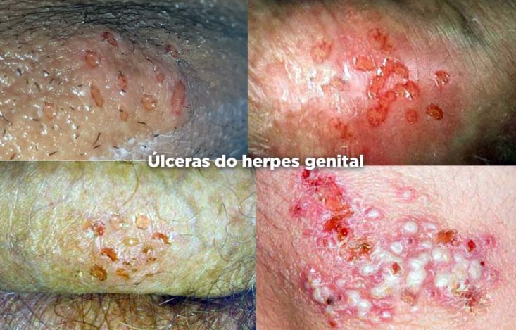 Formação de úlceras no herpes genital