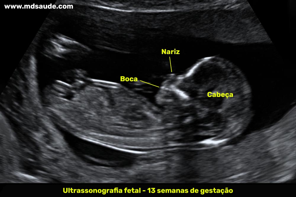 Ultrassom com 13 semanas de gravidez
