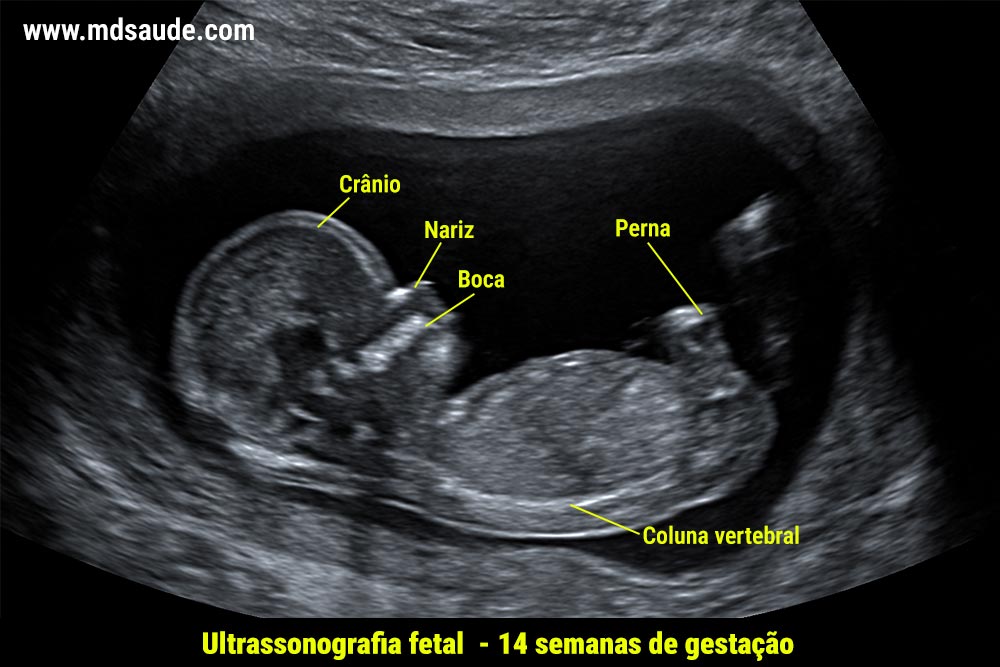 Ultrassom com 14 semanas de gravidez