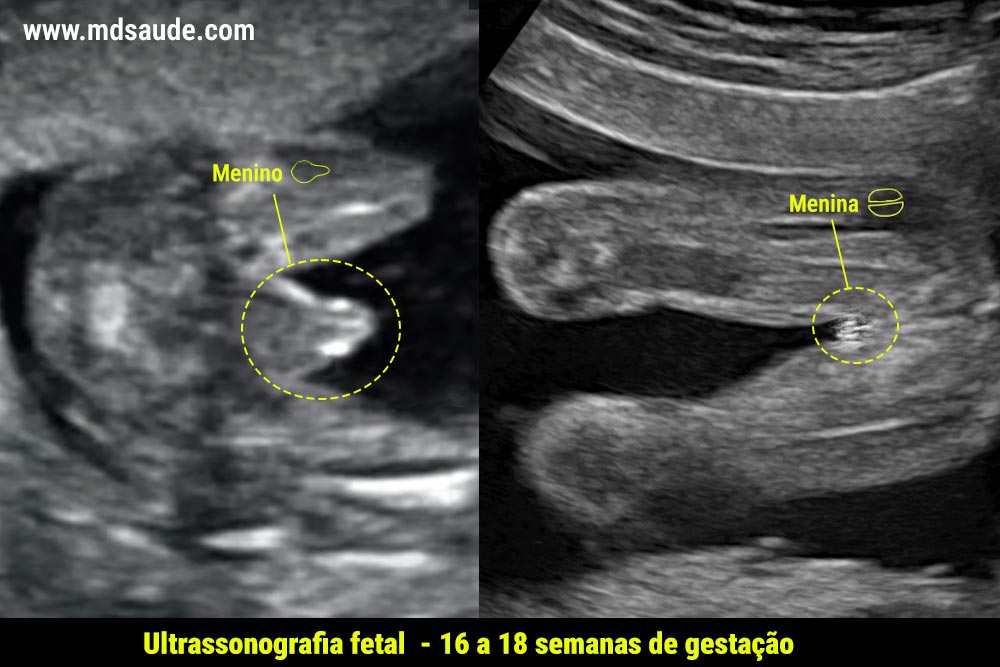 Identificação do sexo do bebê através da ultrassonografia.