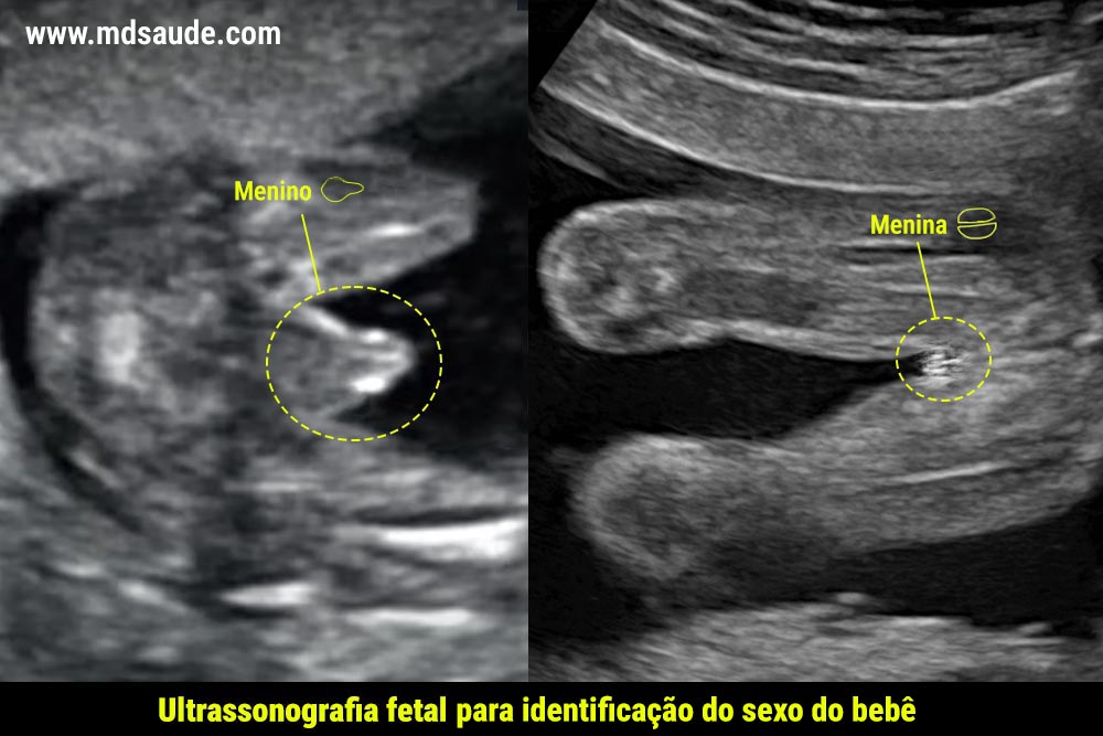 Identificação do sexo do bebê através da ultrassonografia.