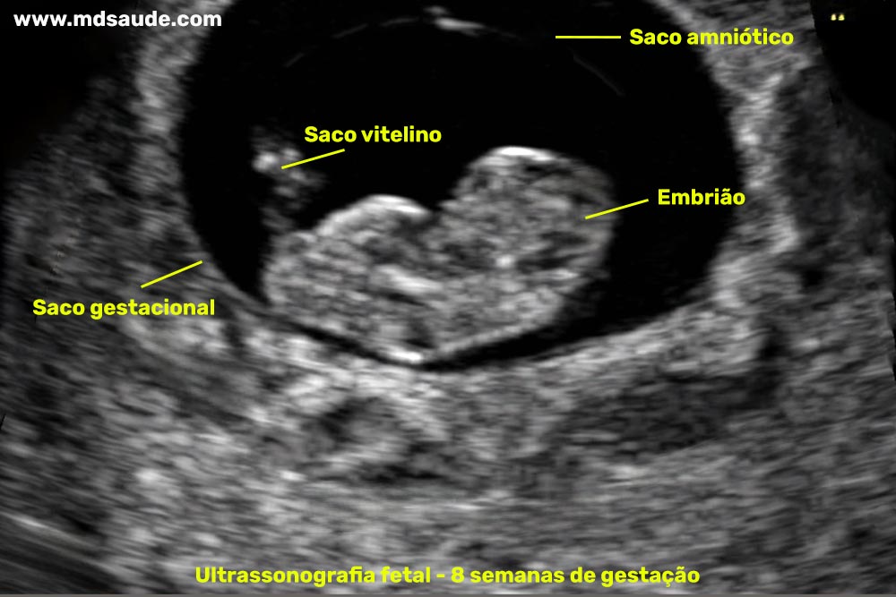 Ultrassom com 8 semanas de gravidez