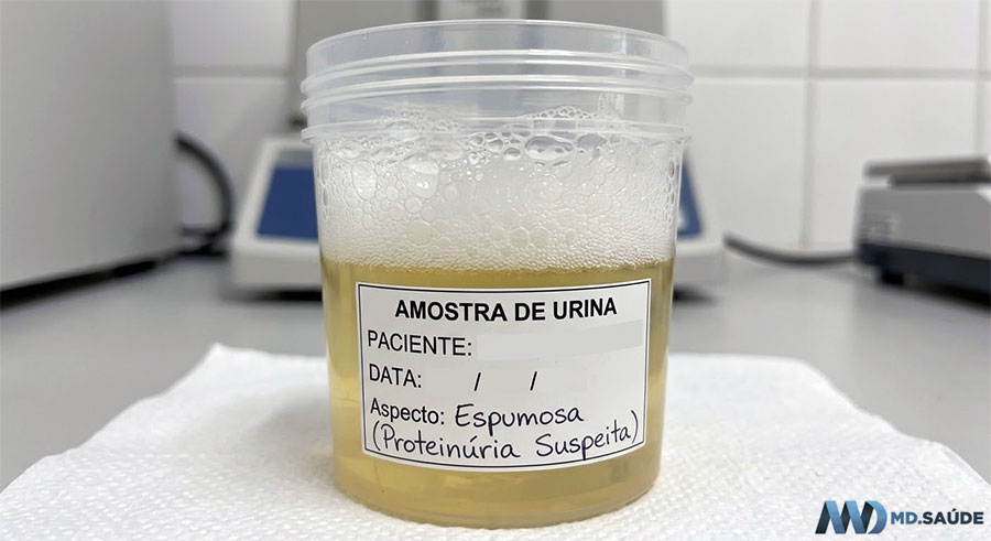 Urina espumosa em frasco de EAS