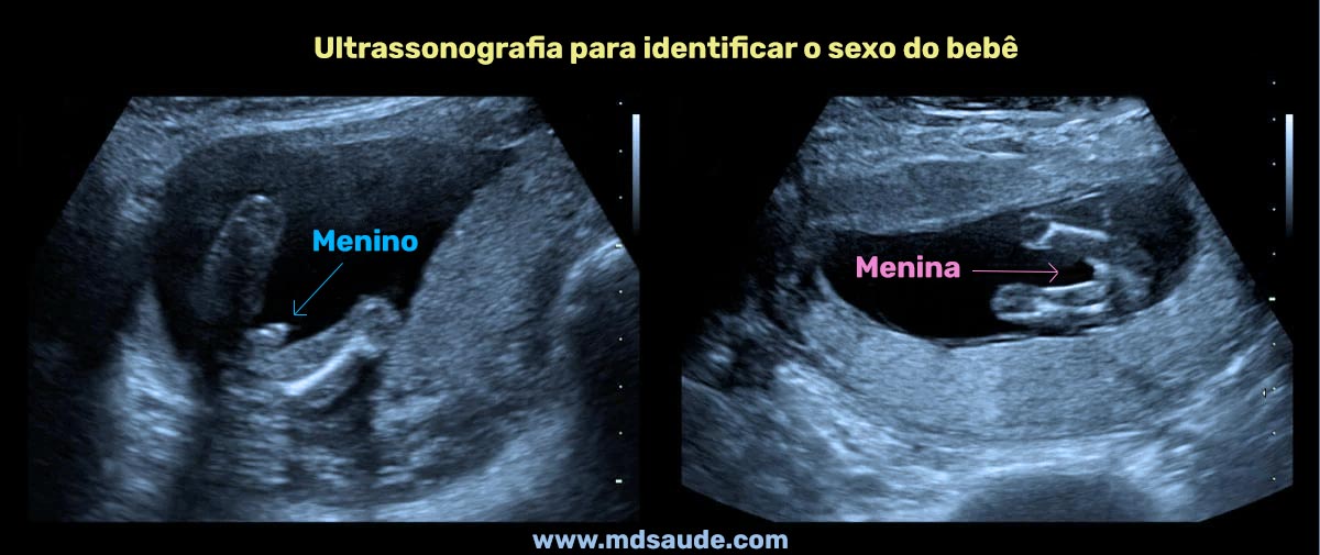 Ultrassonografia para identificar o sexo do bebê