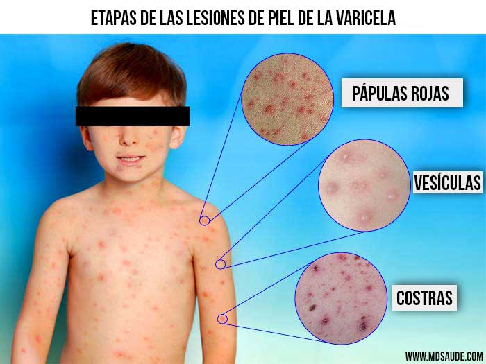 sarpullido de la varicela