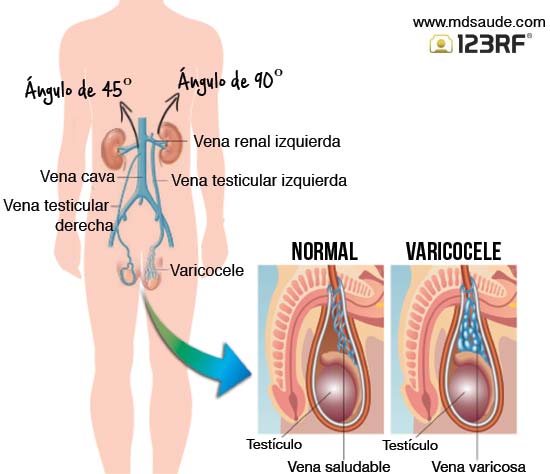 Varicocele