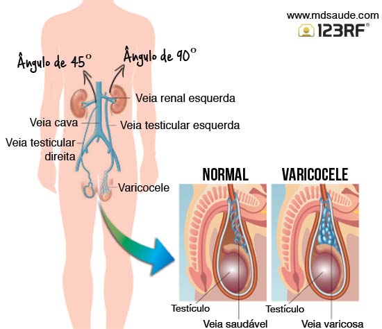 Varicocele