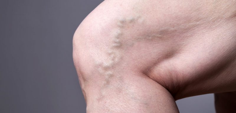 Varices en la pierna
