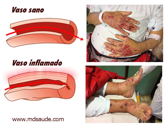 Vasculitis con lesiones cutáneas