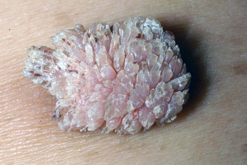 Verruga filiforme em close