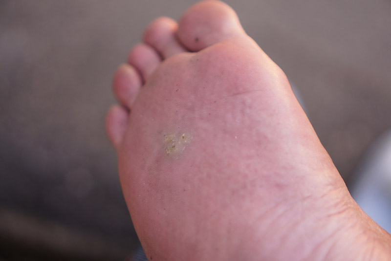 Verruga plantar