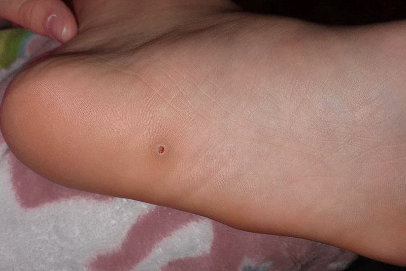 Verruga plantar (olho de peixe no pé)