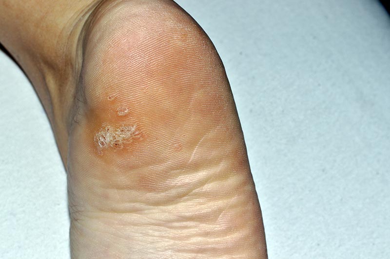 Verruga plantar na base do calcanhar