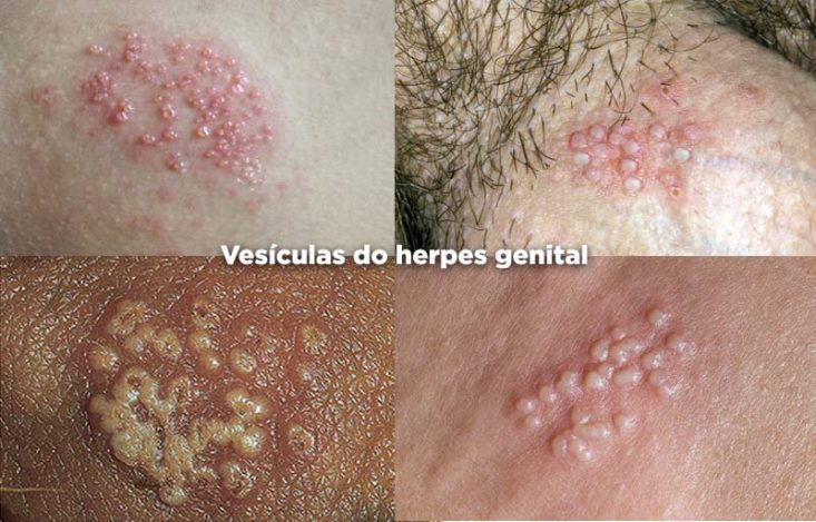 Bolhas do herpes genital