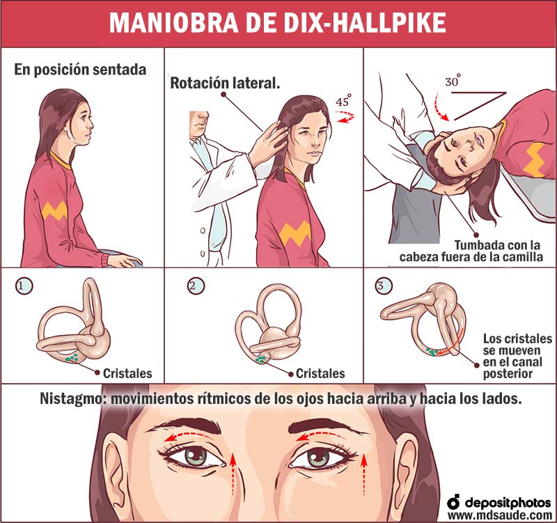 Maniobra de Dix-Hallpike