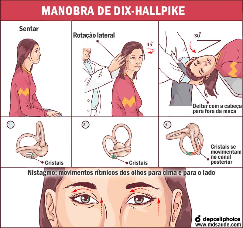Manobra de Dix-Hallpike