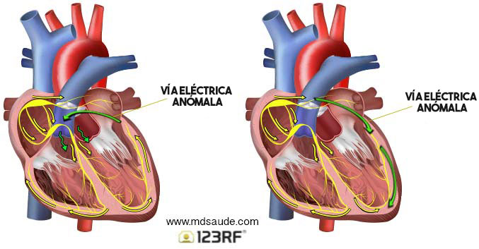 Vías eléctricas anómalas