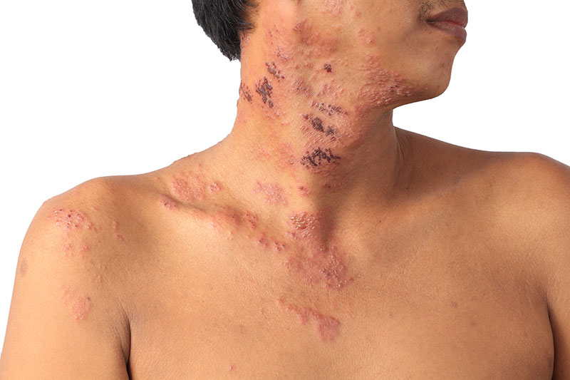 Extensive herpes zoster lesion in the process of resolution